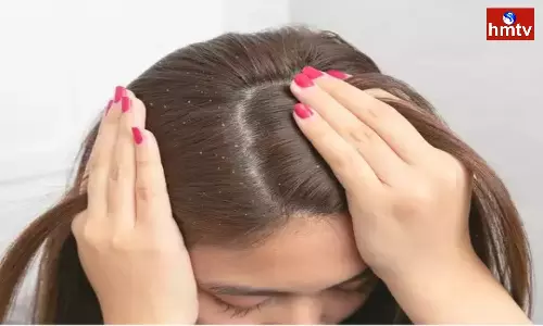 Remove dandruff problem with lemon follow these tips