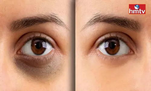 Remove Dark Circles With Aloe Vera Use These 3 Ways