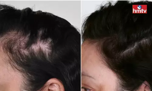 Zinc Deficiency Causes Hair Loss These 5 Foods Provide Zinc