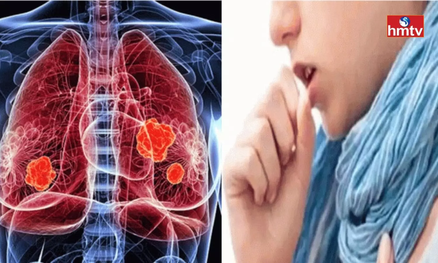 Lung Cancer Symptoms and Treatment Lung Cancer Symptoms and Treatment