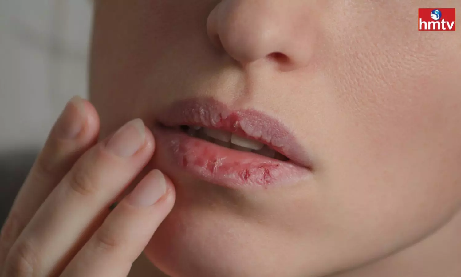 Chapped Lips are Troublesome so Follow These Home Remedies in Winter