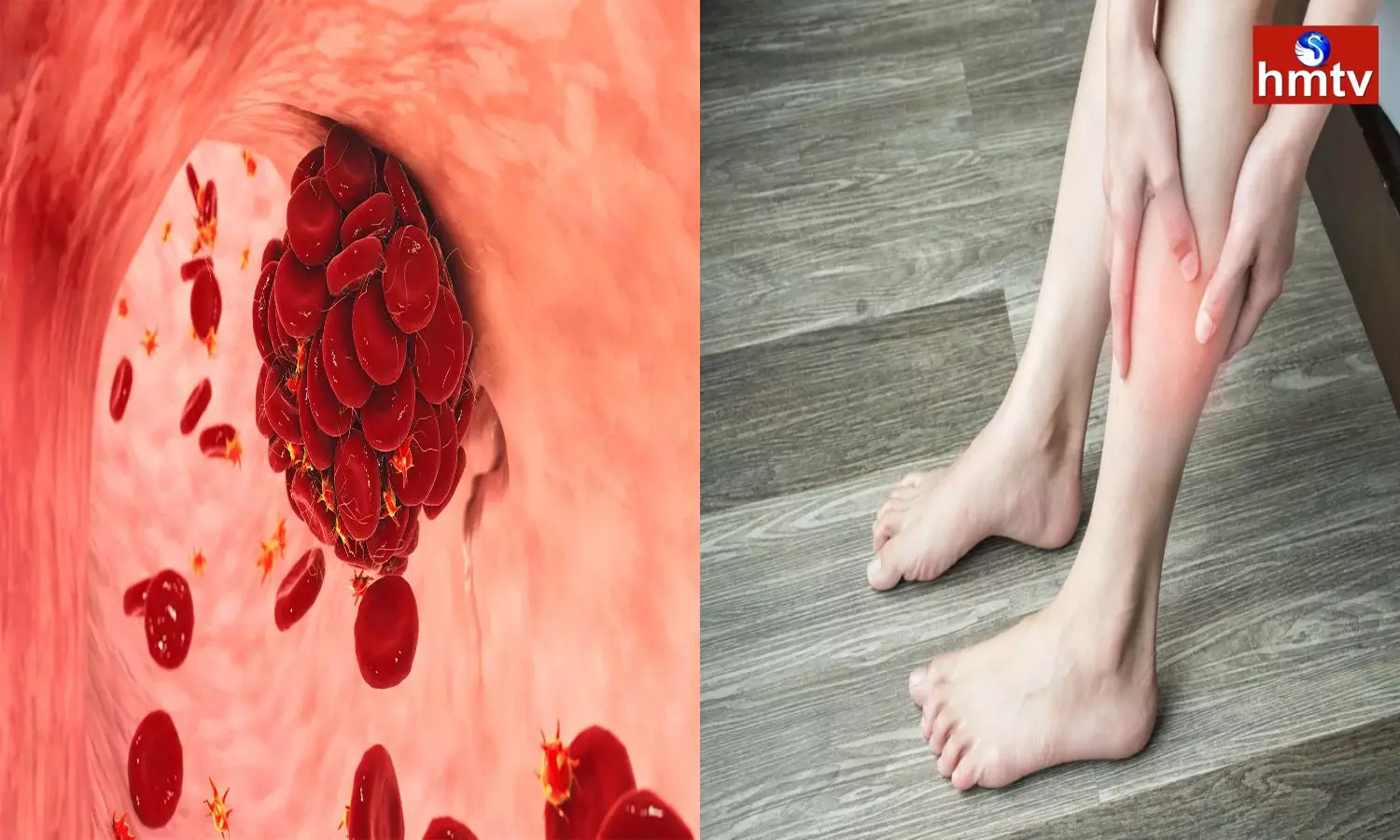 Blood clots in the veins are very troublesome these tips will give relief