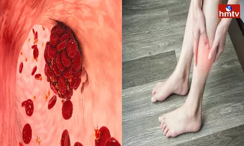 Blood clots in the veins are very troublesome these tips will give relief Blood clots in the veins are very troublesome these tips will give relief