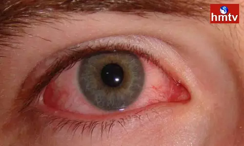 Tamil Nadu People Suffering With Madras Eye