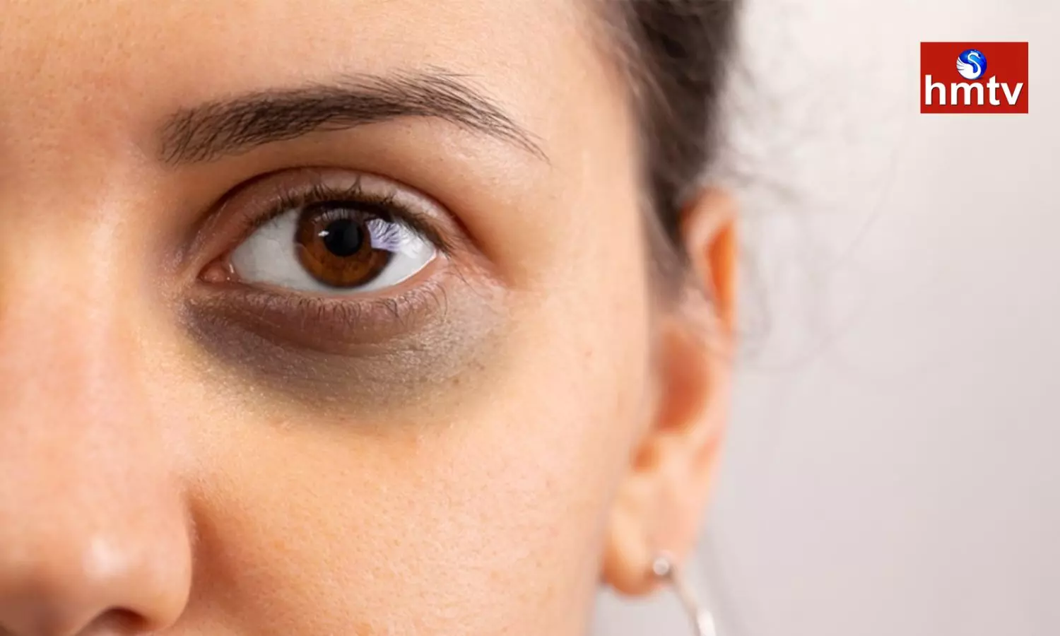 Dark Circles Due to Stress do This for Instant Relief