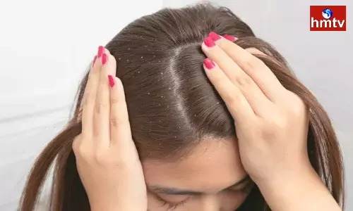 Are you troubled by dandruff it will be completely removed by these natural methods Are you troubled by dandruff it will be completely removed by these natural methods