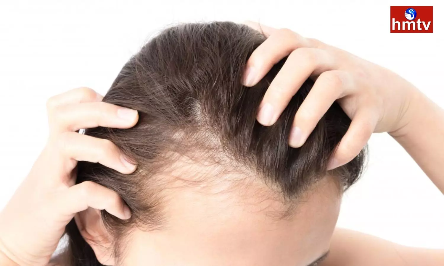 Hair Loss Causes Baldness Apply Coconut Oil Daily to Prevent it