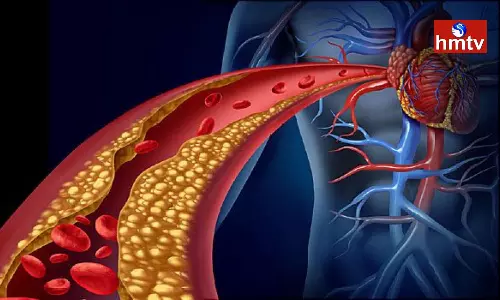 If you eat These Foods fat Accumulates in the Blood Vessels Leave it Today If you eat These Foods fat Accumulates in the Blood Vessels Leave it Today