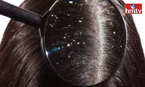 Is the Problem of Dandruff Bothering you in Winter If you Follow This tip you Will get Immediate Results
