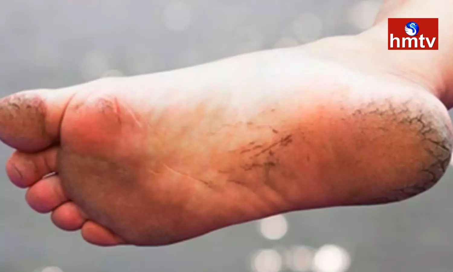 The Beauty of the Feet is Deteriorating due to Cracked Heels Follow These Tips and Avoid it