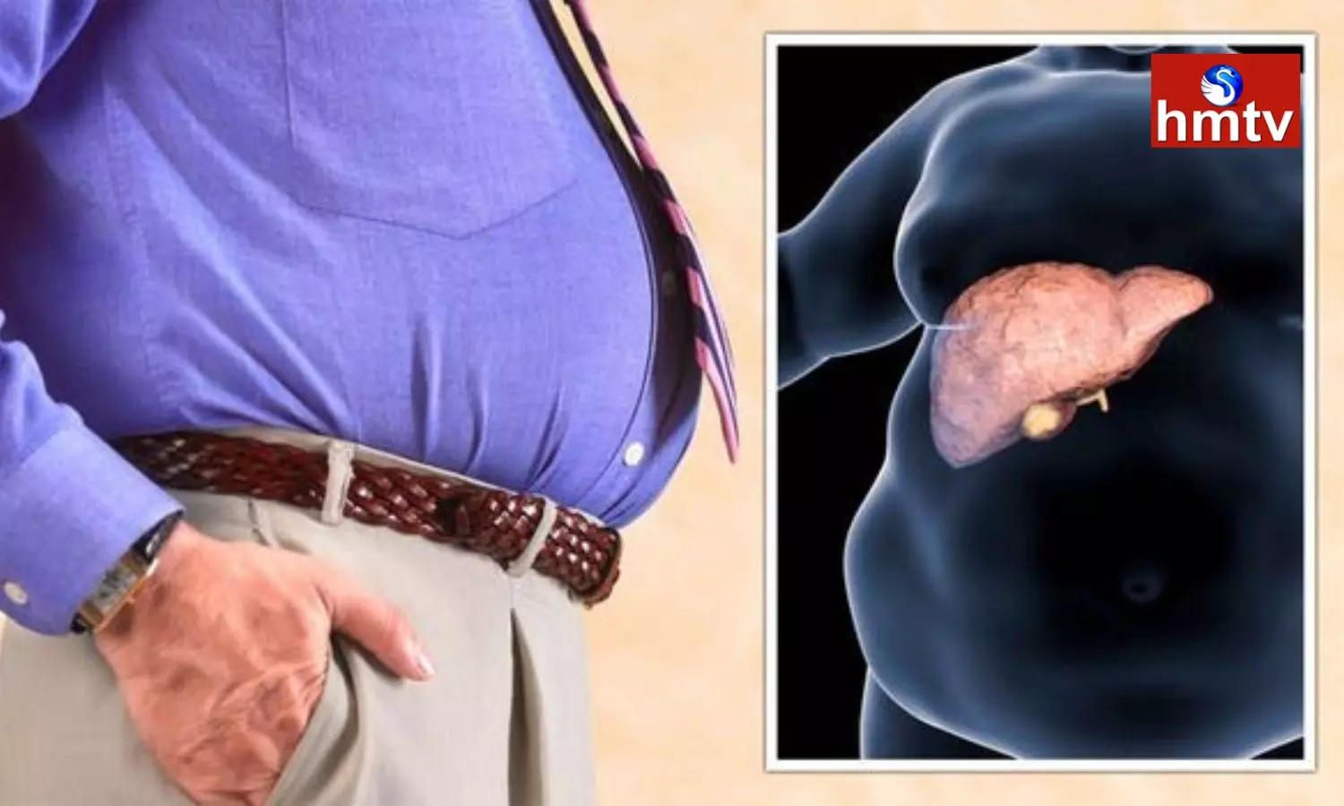 Fatty Liver Disease is Possible for Those who are Overweight and Obese Take These Precautions