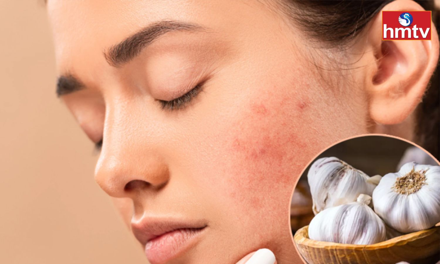 Health Tips వెల్లుల్లితో మొటిమలకి చెక్.. ఎలా ఉపయోగించాలో తెలుసుకోండి