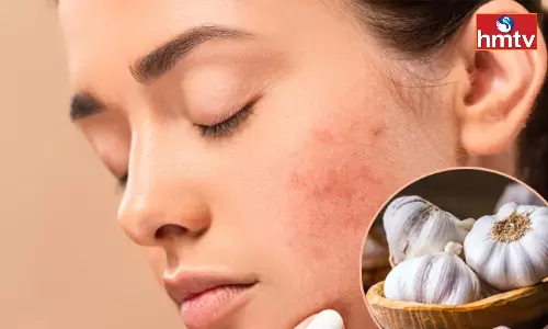 Check Acne With Garlic Learn how to use it Check Acne With Garlic Learn how to use it