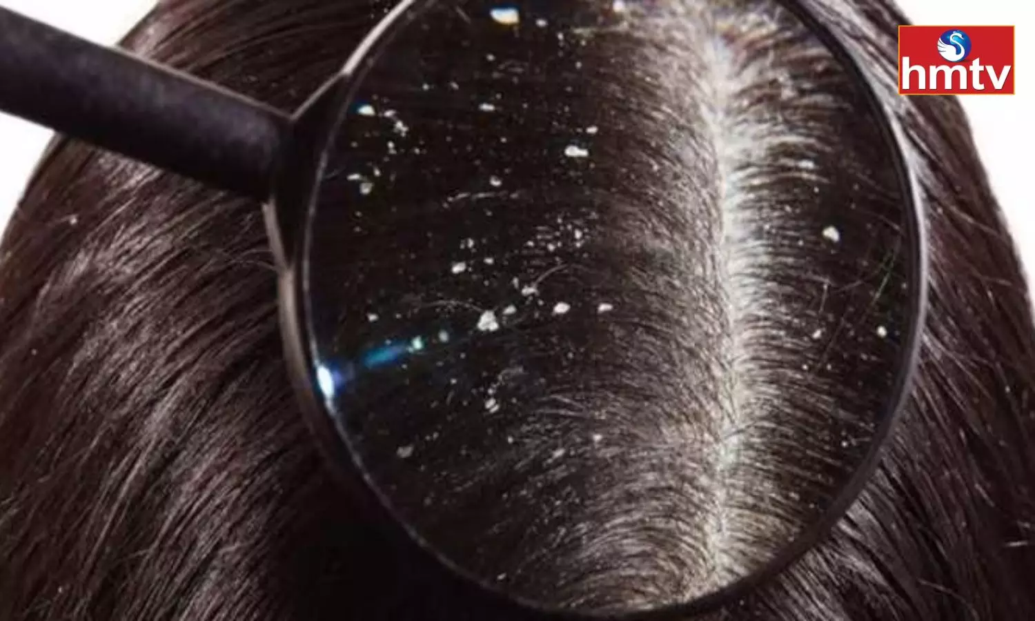 These are the Mistakes you do That are Causing Dandruff Leave Them Today