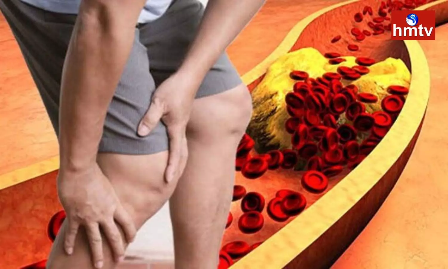 Pain in Legs Thigh and Buttocks May Increase Cholesterol in Your Body Check Symptoms