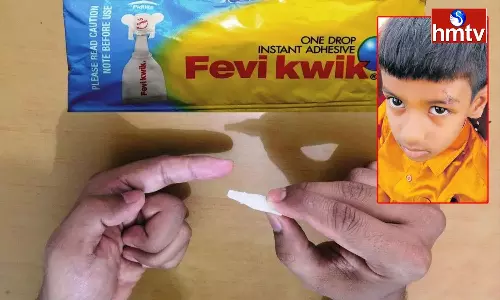 Gadwal Hospital Doctors Show Negligence, Attached Eyes With Fevikwik After Injury Gadwal Hospital Doctors Show Negligence, Attached Eyes With Fevikwik After Injury