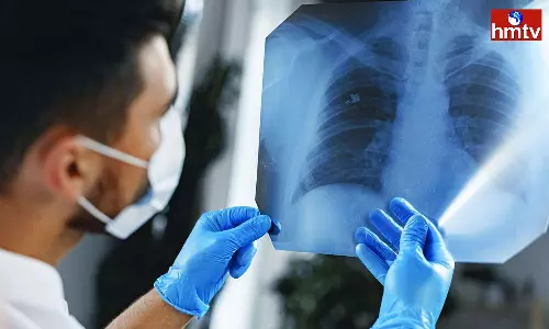 Lung Cancer is Very Dangerous You are Suffering From it Without Knowing it Lung Cancer is Very Dangerous You are Suffering From it Without Knowing it