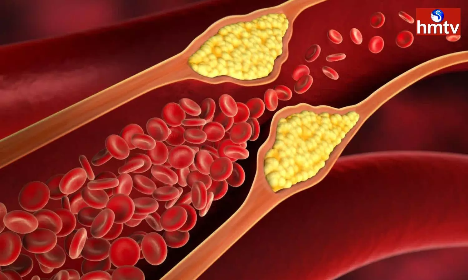 If Bad Habits are The Cause of Bad Cholesterol Problem You will Suffer From These Diseases