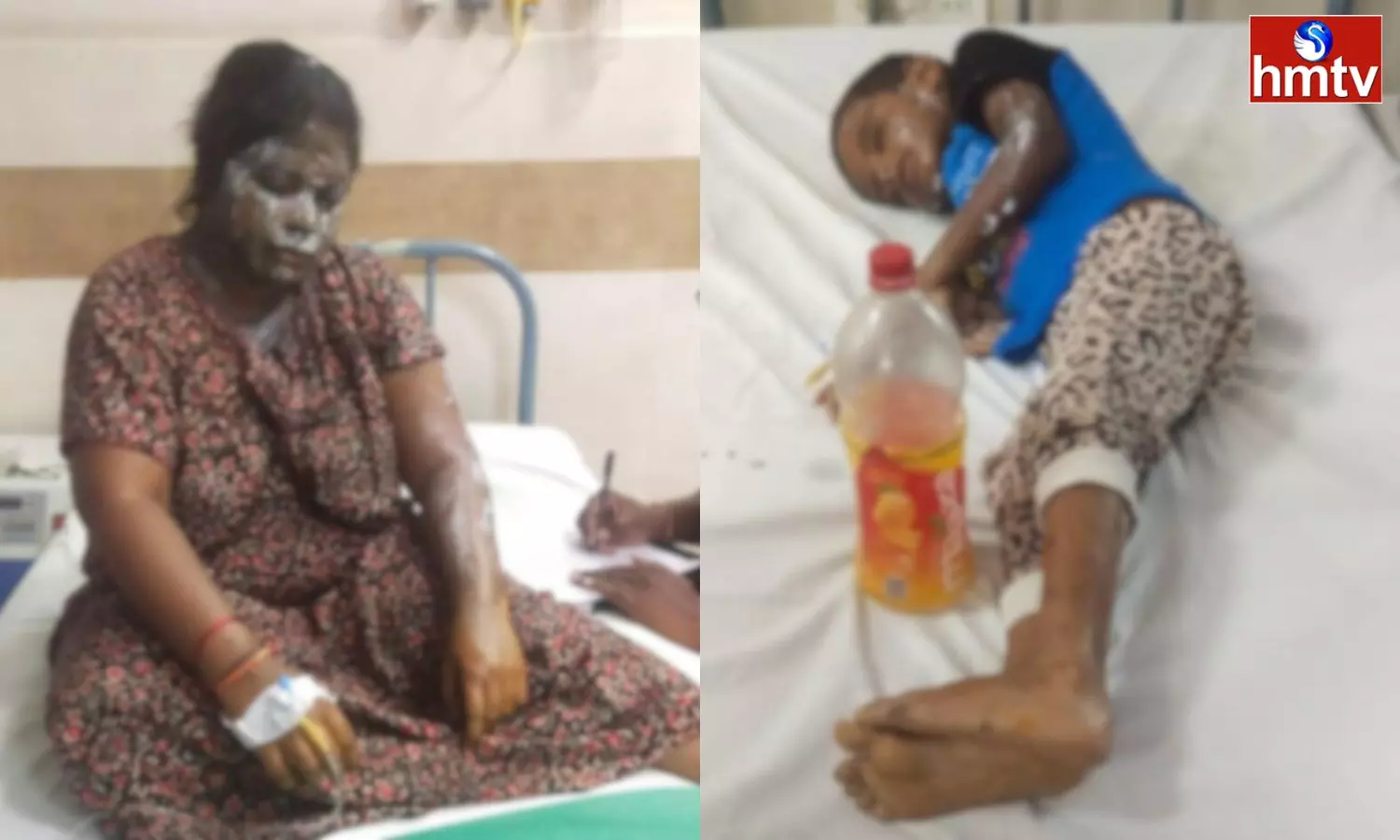 Acid Attack On A Married Woman In Athivaram Of NTR District