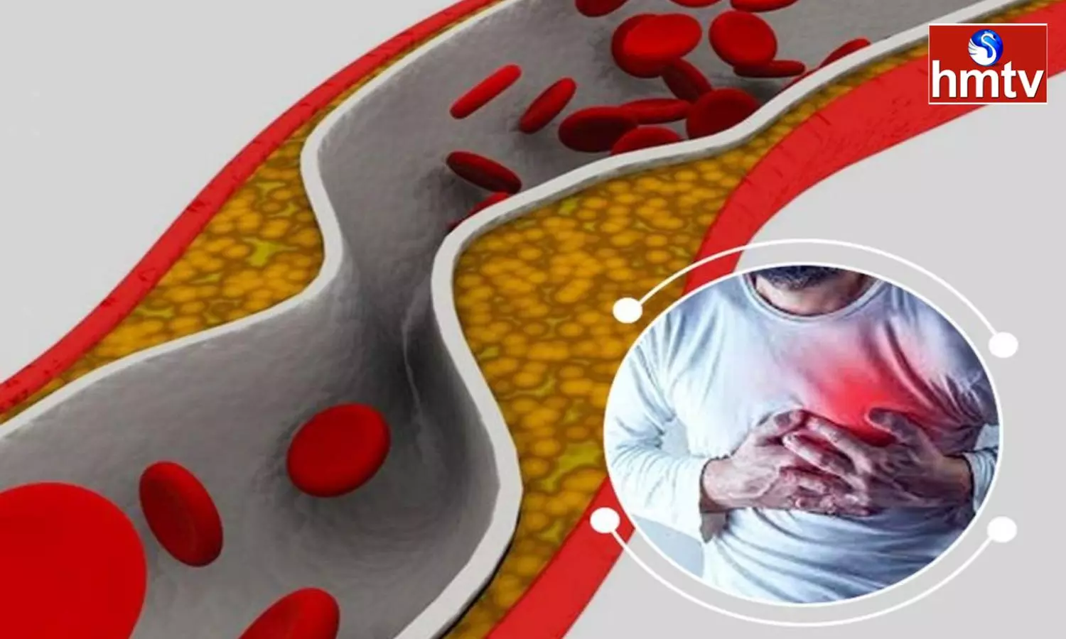 Due to the Increase of Bad Cholesterol These Diseases are Surrounded