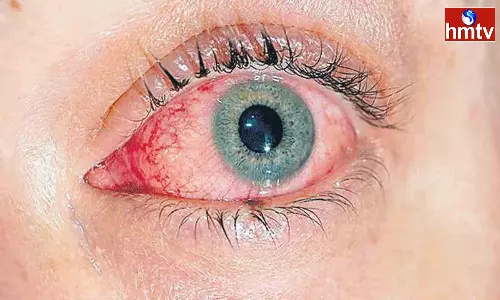 Eye Flu Cases increased in Andhra Pradesh Eye Flu Cases increased in Andhra Pradesh