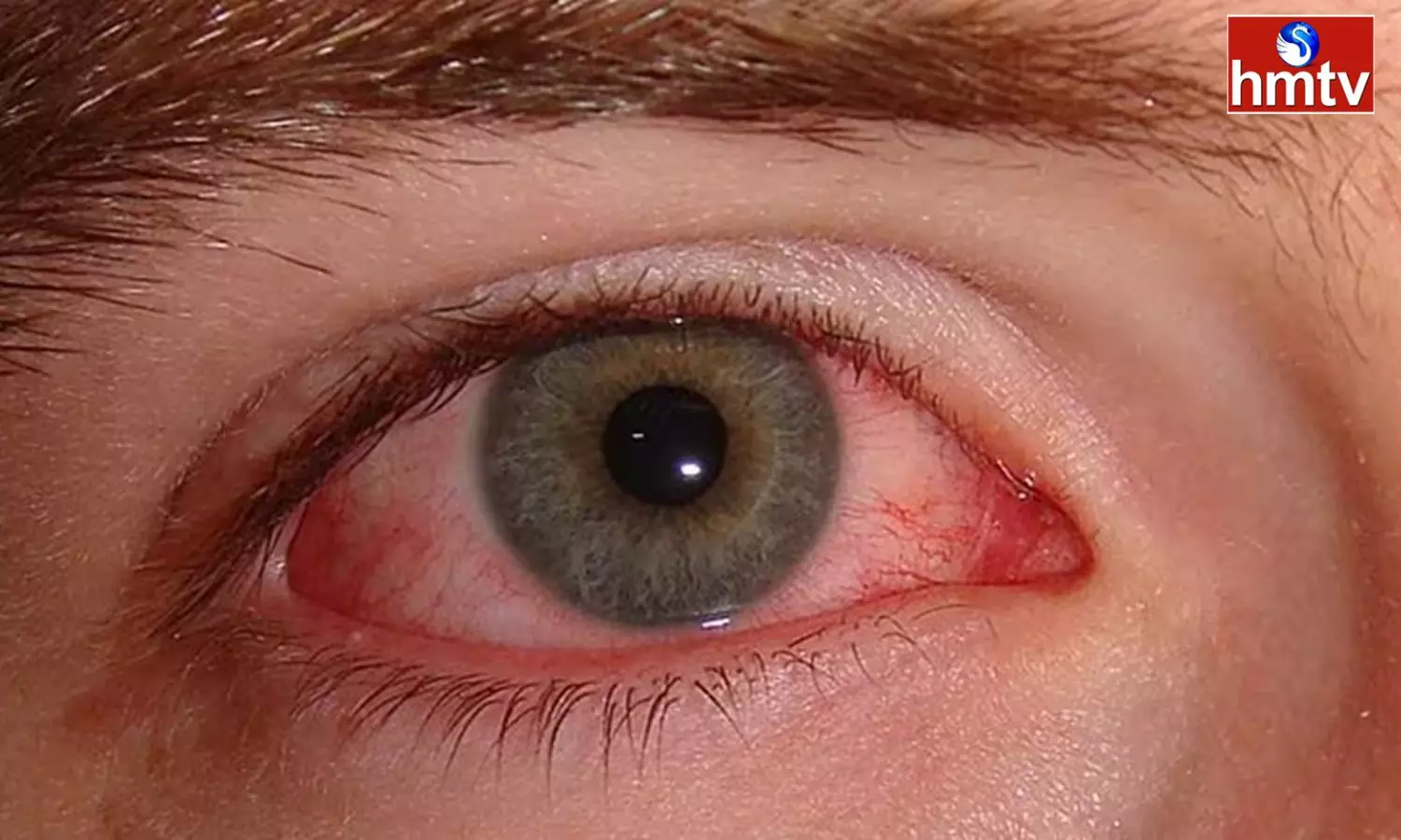 Conjunctivitis Cases Rise in Telugu States Conjunctivitis Cases Rise in Telugu States