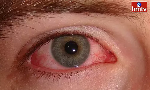 Conjunctivitis Cases Rise in Telugu States
