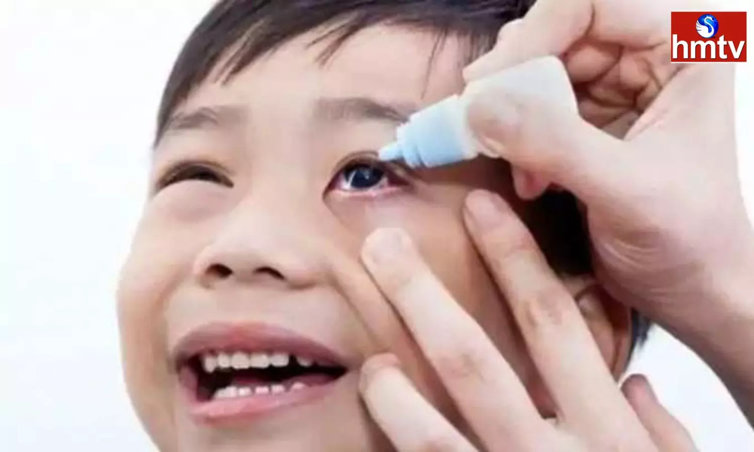 Increasing cases of eye flu Conjunctivitis in Children these Precautions must be followed