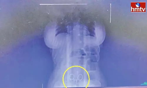 Eluru Government Hospital Doctor Who Left The Scissors In The Stomach