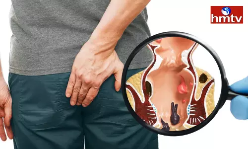 Piles Disease Can Be Prevented With Aloe Vera Try This Way