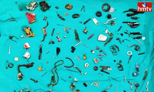 Earphones, Screws Among 100 Items Pulled From Mans Stomach in Punjab