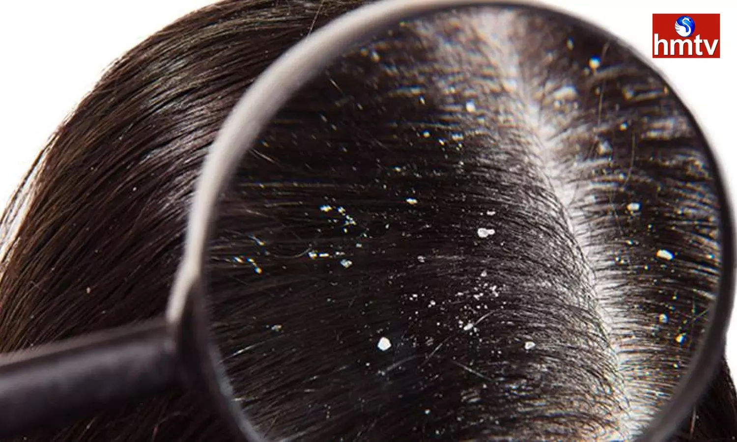 Dandruff Is Bothering You Follow These Tips And Get Rid Of It