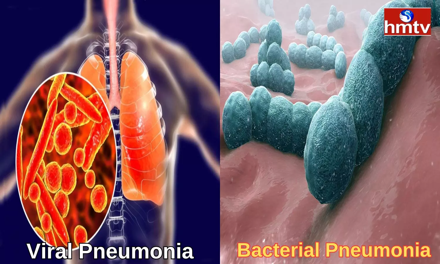 What Is The Difference Between Viral Pneumonia And Bacterial Pneumonia