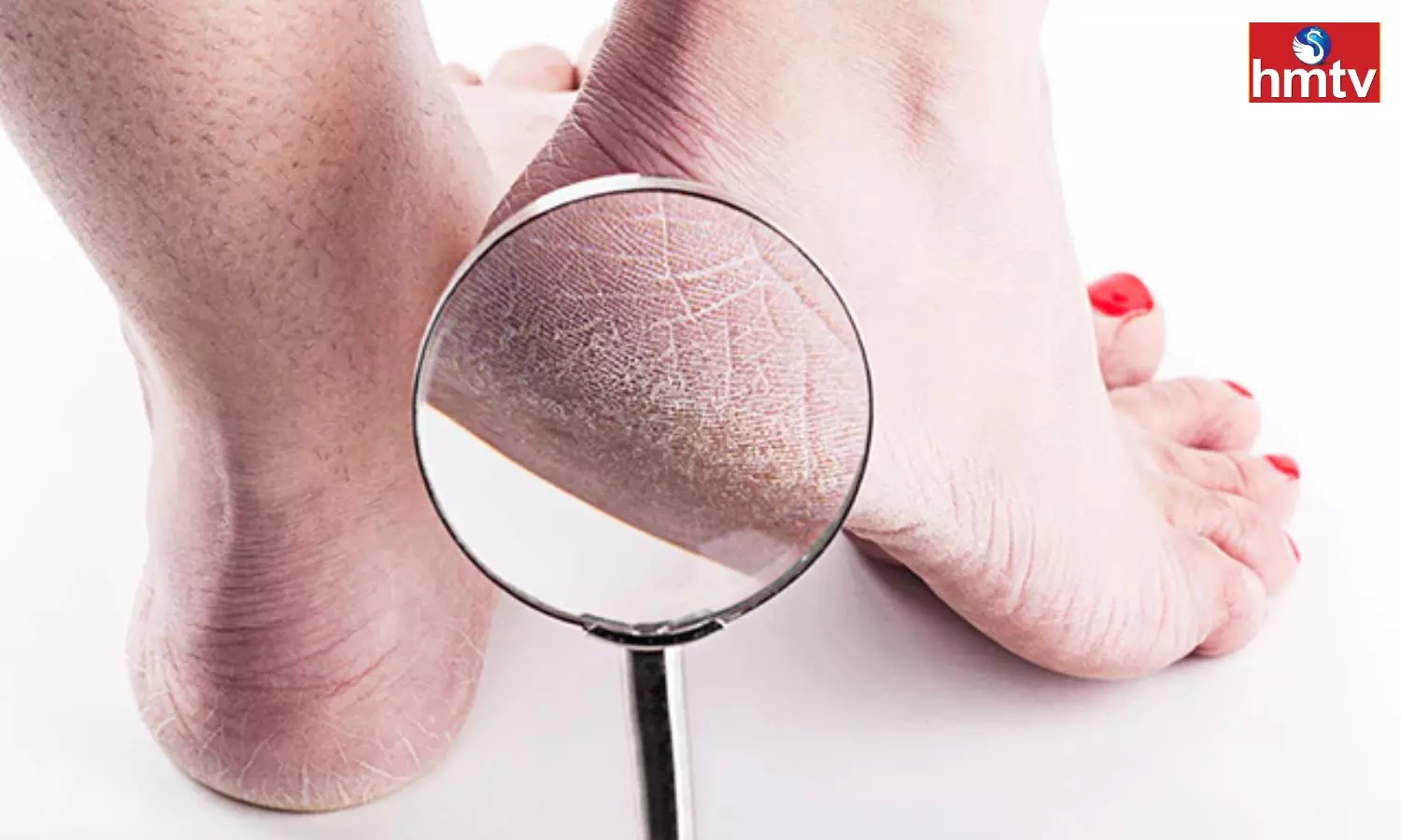 Cracked Heels Are Bothersome In Winter Soften Them With This Method