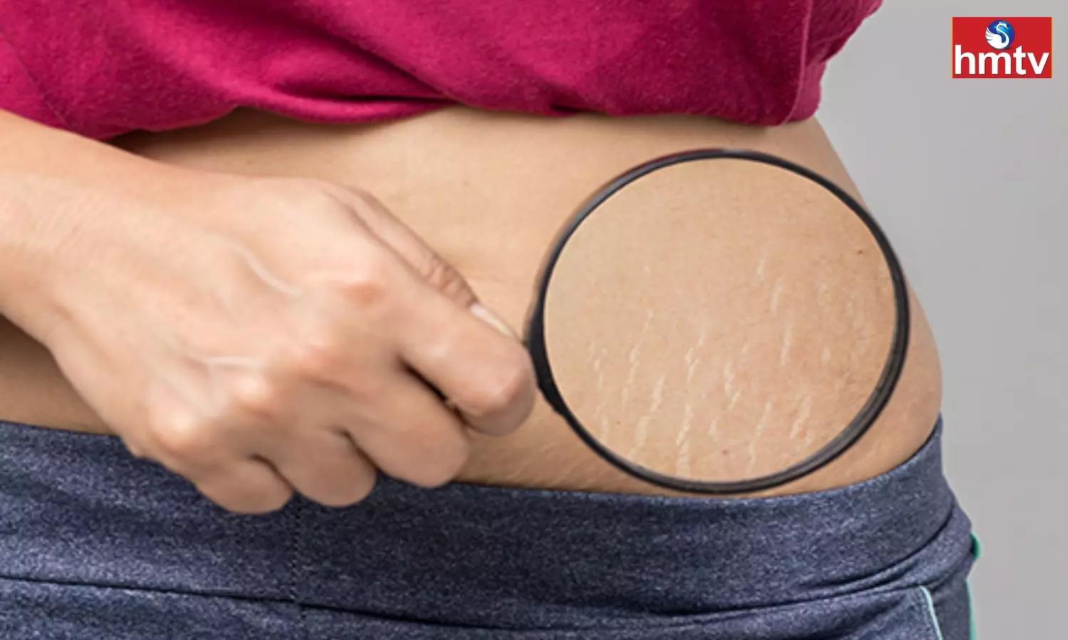 Are You Suffering From Pregnancy Stretch Marks Remove Them Easily