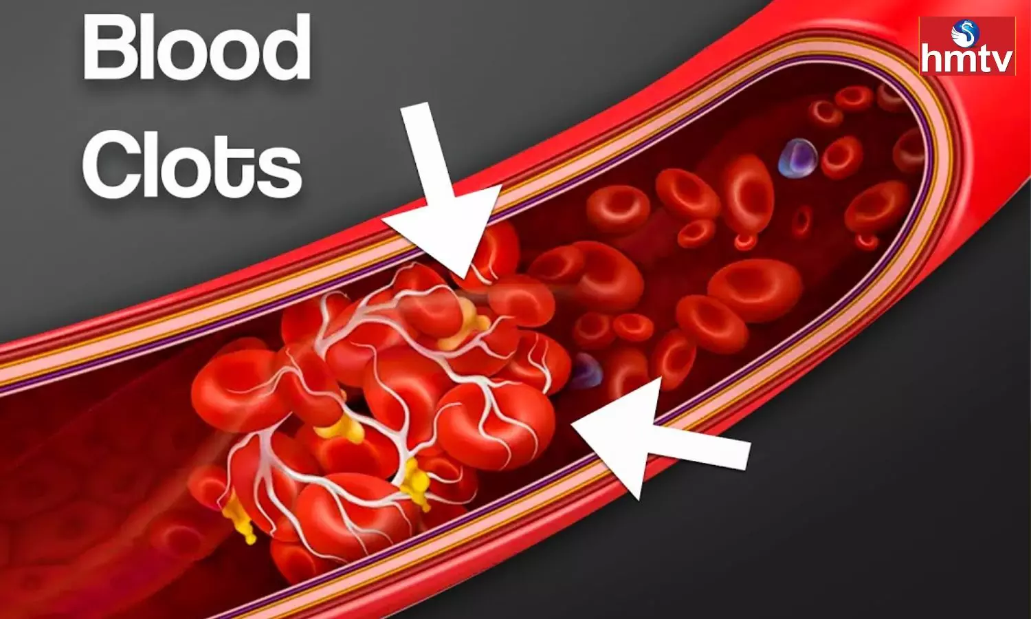 The Problem Of Blood Clots Is More In Winter If These Symptoms Appear Consult A Doctor
