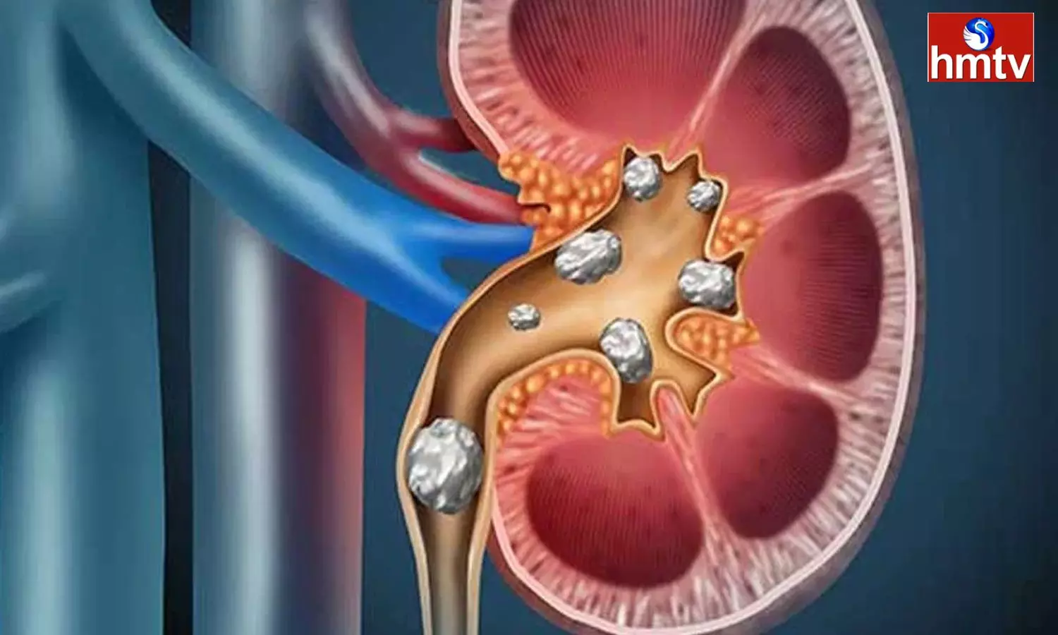 Do You Have Stones In The Kidney Know The Reasons And Treatment Method