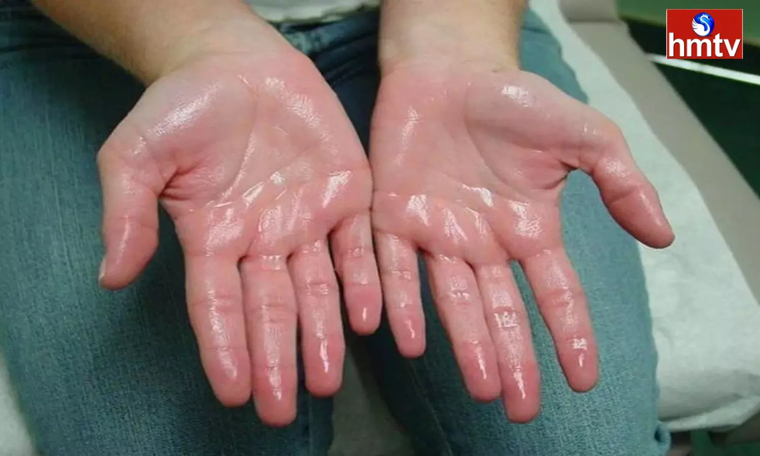 Are Your Palms Sweating It May Be A Dangerous Disease