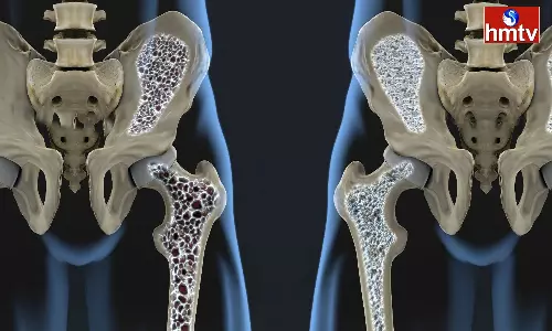 Bones Will Be Damaged If These Substances Are Eaten Stay Away From Today