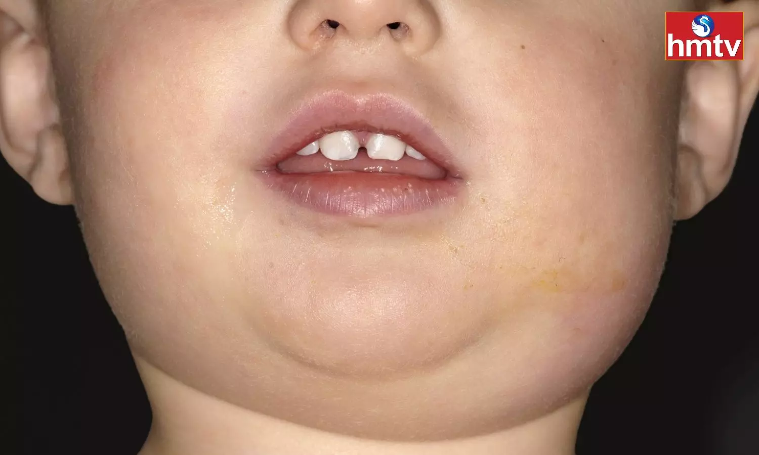 Mumps Booming In Children Know The Symptoms And Treatment Method
