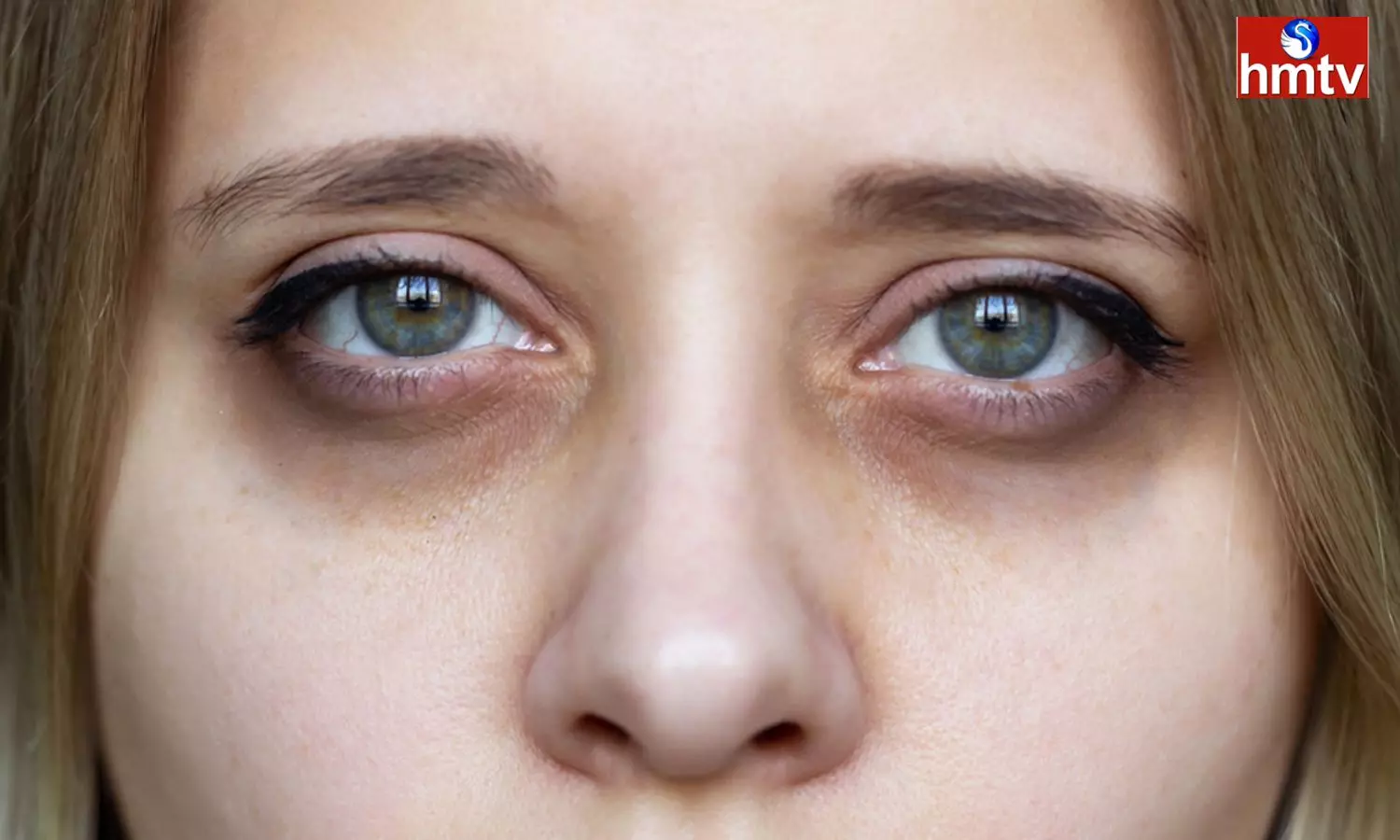 Cant go out with Dark Circles Under Eyes in Summer Follow these Natural Tips