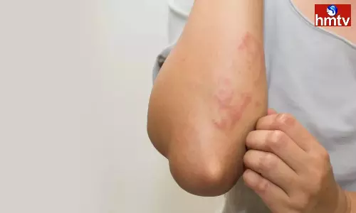 Dont Worry If You Are Allergic Take These Steps If You Experience These Symptoms