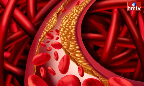 Do you have high cholesterol percentage in the body know these Remedies