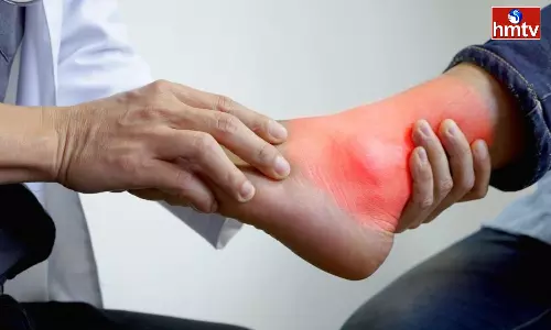 Know the Causes of Uric Acid Symptoms in the Body Know the Causes of Uric Acid Symptoms in the Body