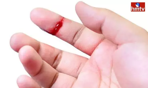 Blood Clots when you get hit or find out if you Have Hemophilia