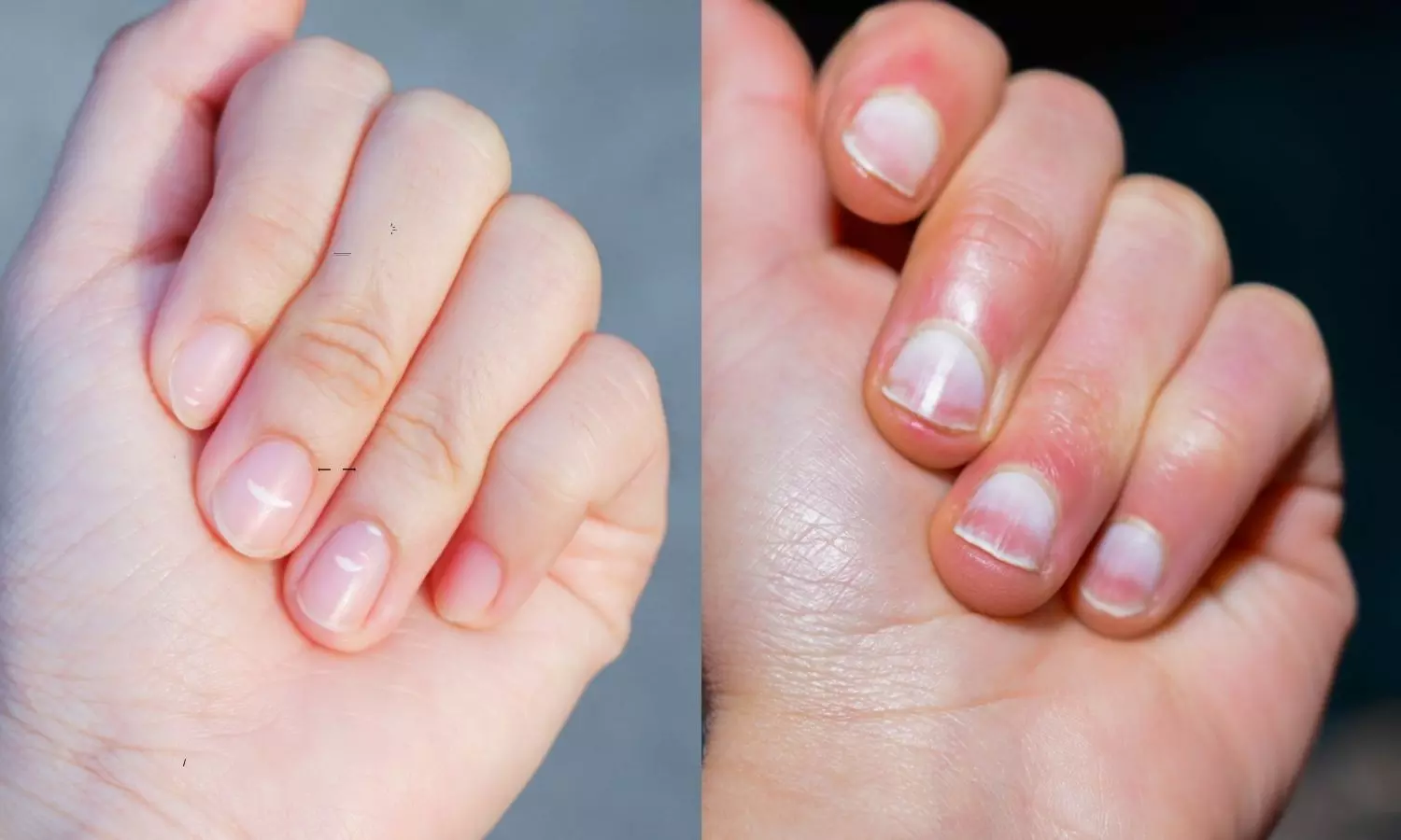 Fingernail Signs How Your Fingernails Can Show Signs of Disease