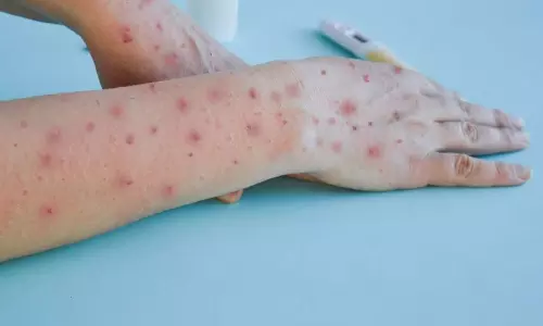 Cases of monkeypox are increasing worldwide Cases of monkeypox are increasing worldwide