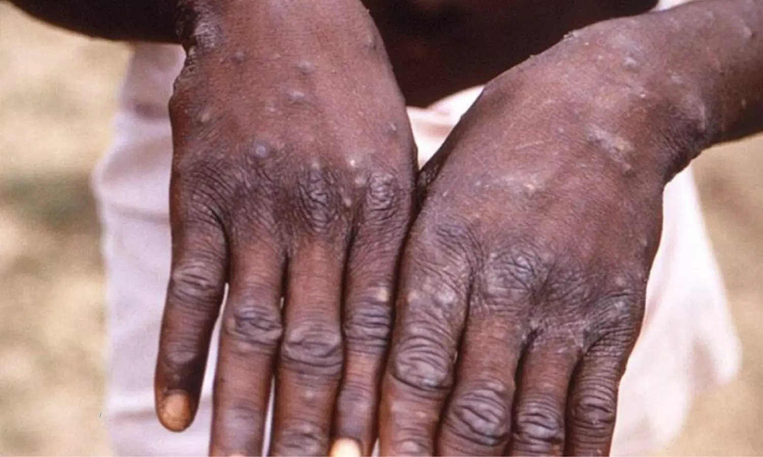 AIIMS issued key guidelines on monkeypox