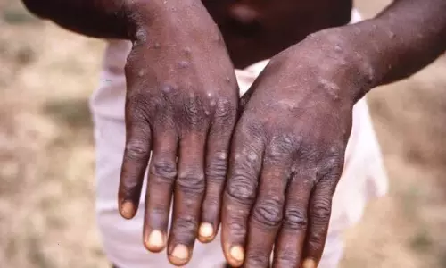 Monkey disease is also causing a stir in India Monkey disease is also causing a stir in India