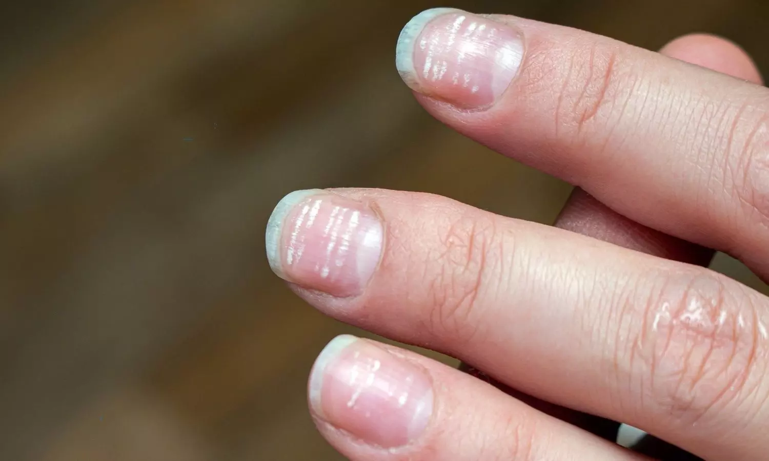 These are the health issue if your nails turn into white color